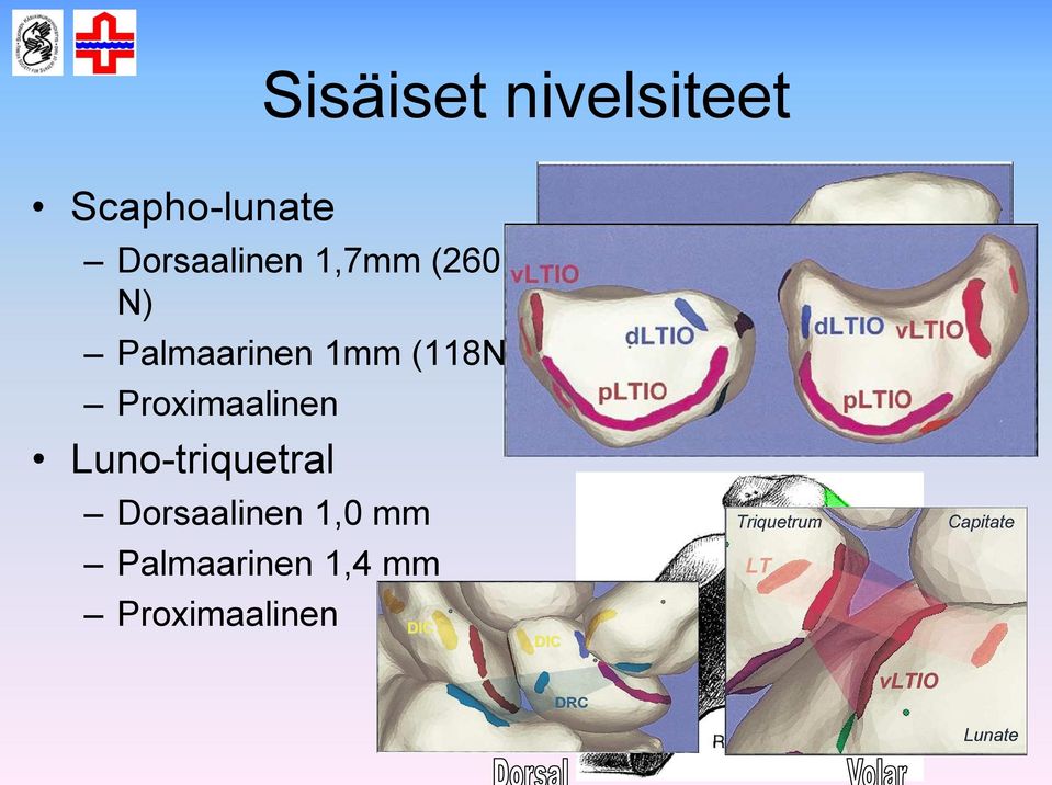 (118N) Proximaalinen Luno-triquetral