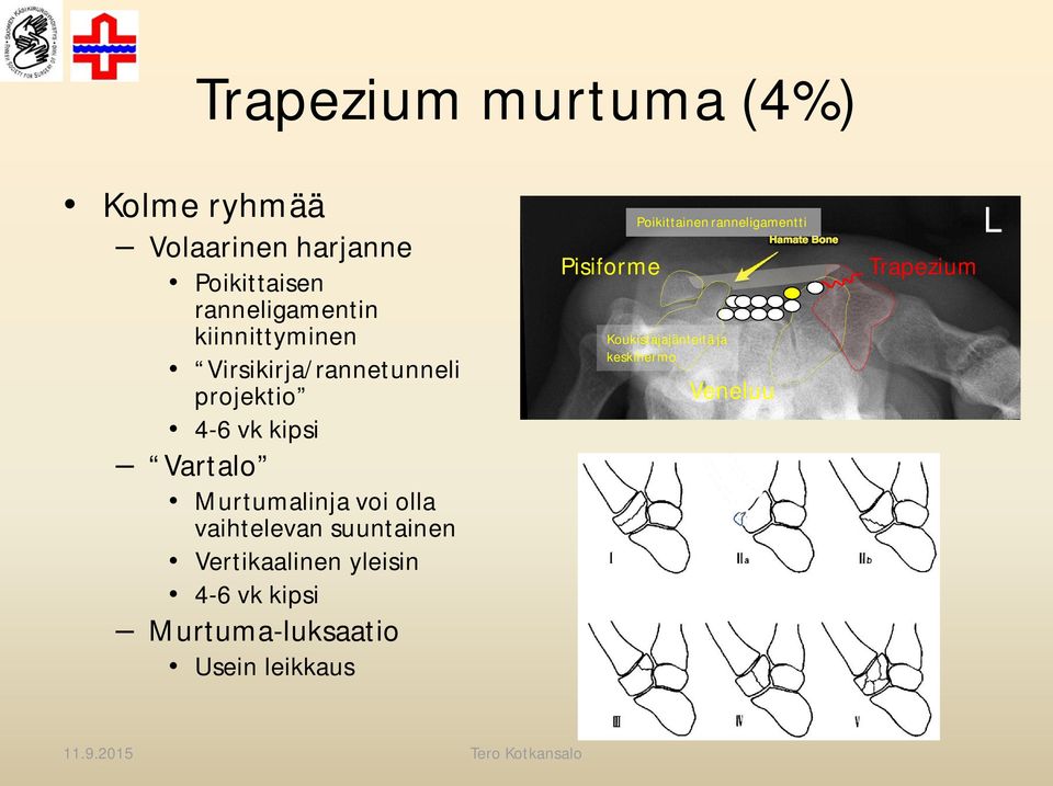 olla vaihtelevan suuntainen Vertikaalinen yleisin 4-6 vk kipsi Murtuma-luksaatio Usein