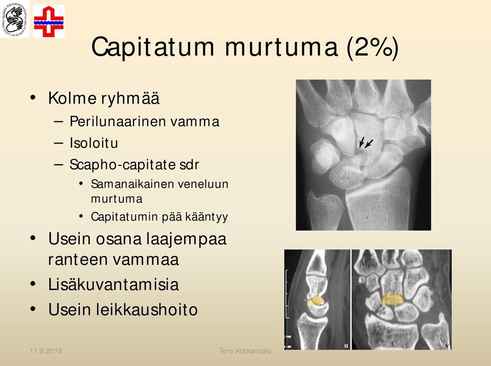 veneluun murtuma Capitatumin pää kääntyy Usein osana