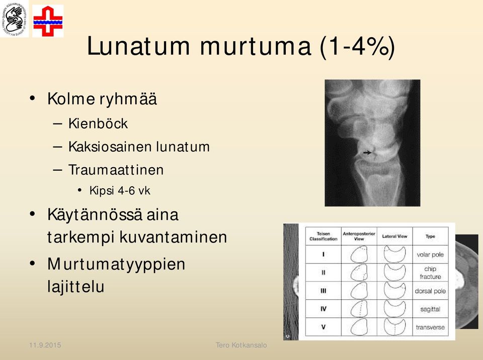 Traumaattinen Kipsi 4-6 vk Käytännössä