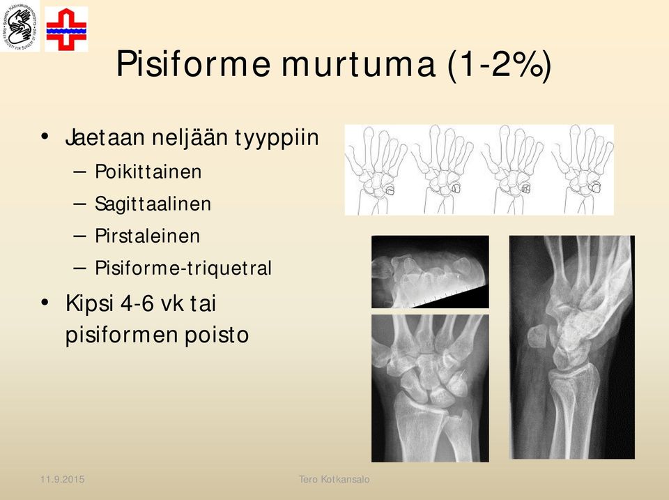 Sagittaalinen Pirstaleinen