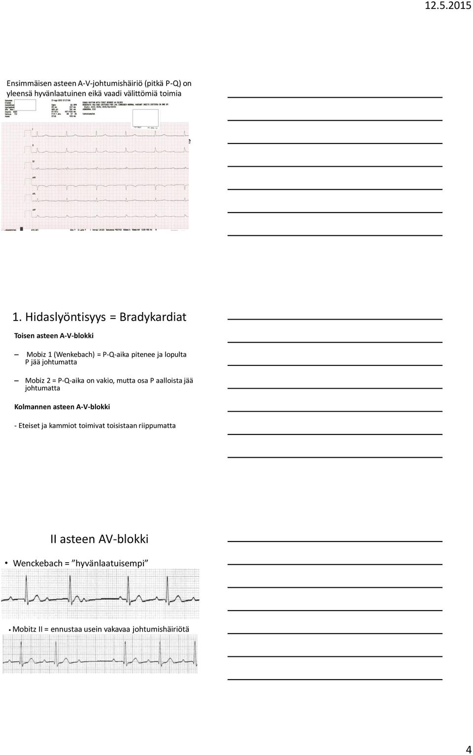 Hidaslyöntisyys = Bradykardiat Toisen asteen AVblokki Mobiz 1 (Wenkebach) = PQaika pitenee ja lopulta P jää johtumatta Mobiz 2 = PQaika on vakio,