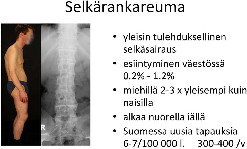 2% miehillä 2 3 x yleisempi kuin naisilla alkaa