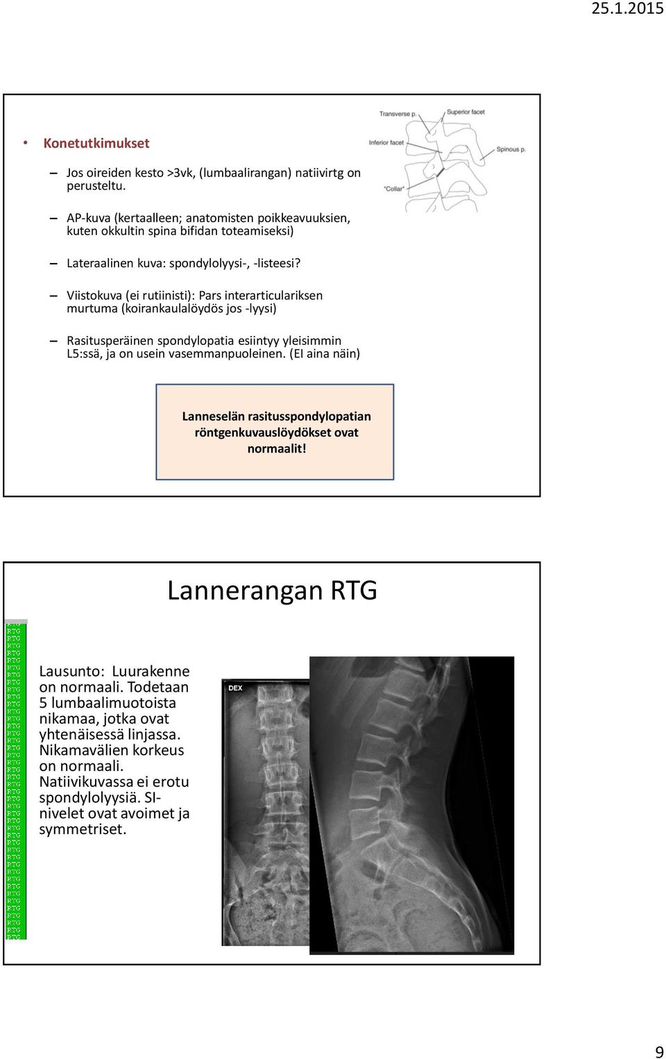 Viistokuva (ei rutiinisti): Pars interarticulariksen murtuma (koirankaulalöydös jos -lyysi) Rasitusperäinen spondylopatia esiintyy yleisimmin L5:ssä, ja on usein vasemmanpuoleinen.