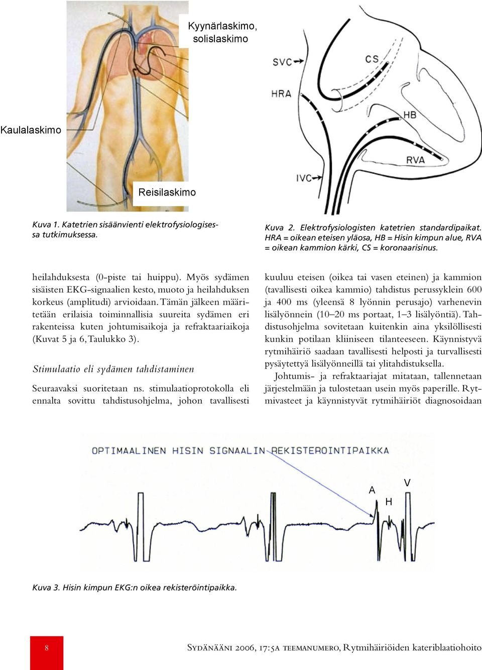Myös sydämen sisäisten EKG-signaalien kesto, muoto ja heilahduksen korkeus (amplitudi) arvioidaan.