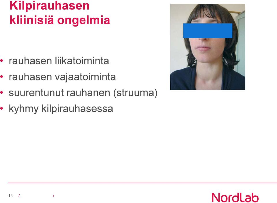 vajaatoiminta suurentunut rauhanen