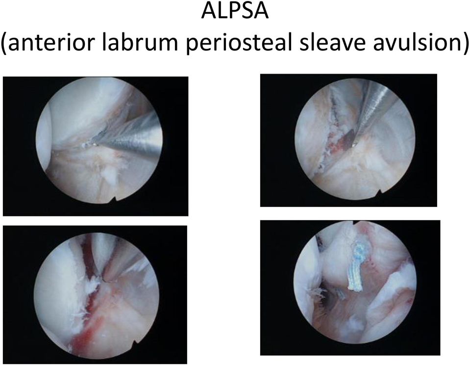 labrum