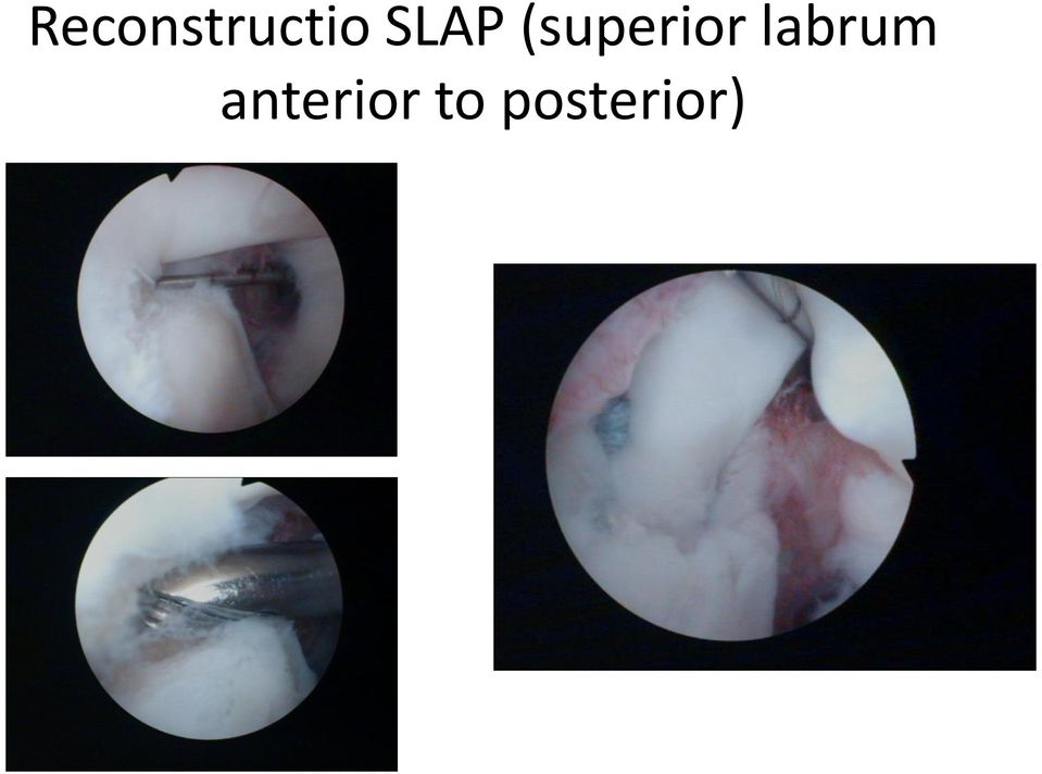 labrum