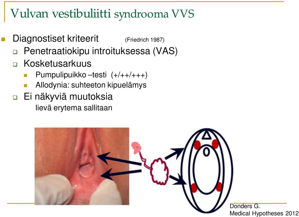 Kosketusarkuus Pumpulipuikko testi (+/++/+++) Allodynia: suhteeton