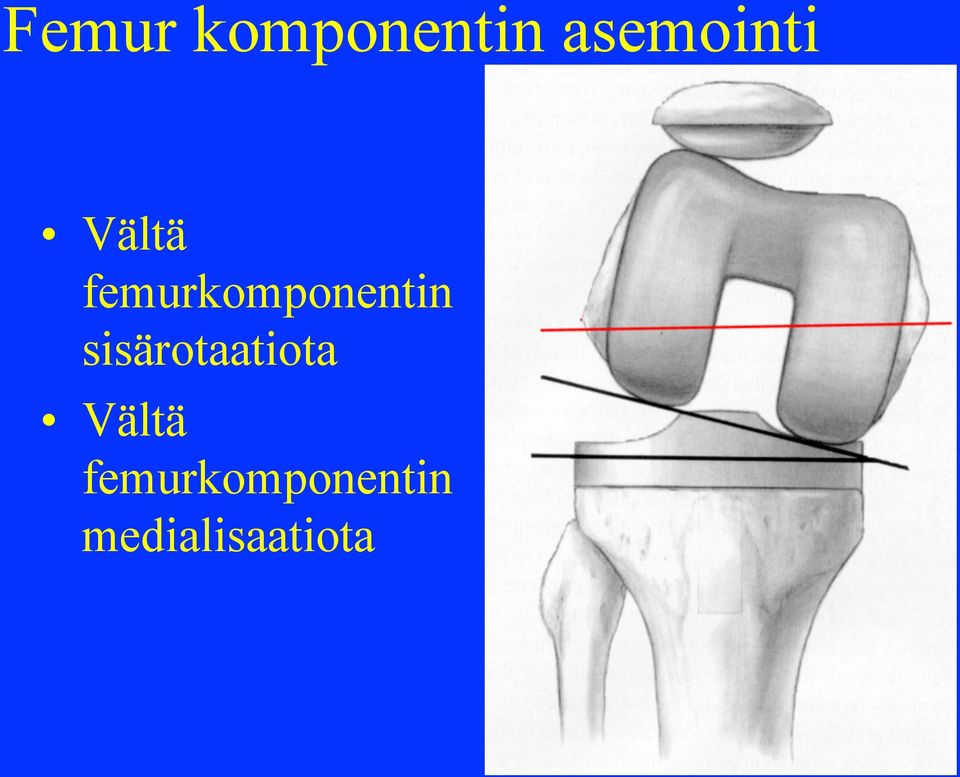 femurkomponentin