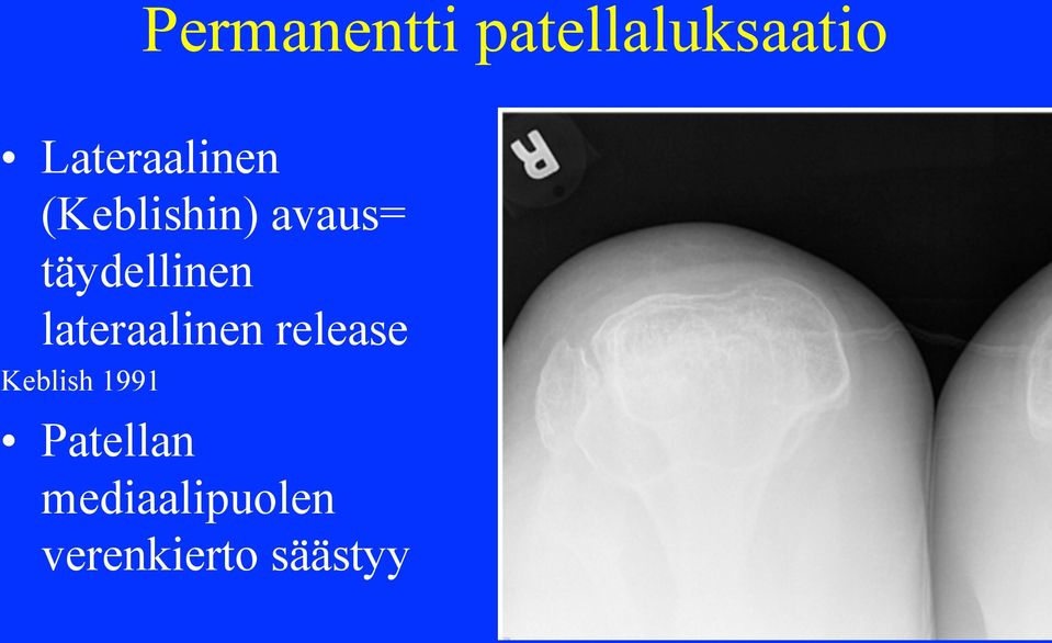 täydellinen lateraalinen release