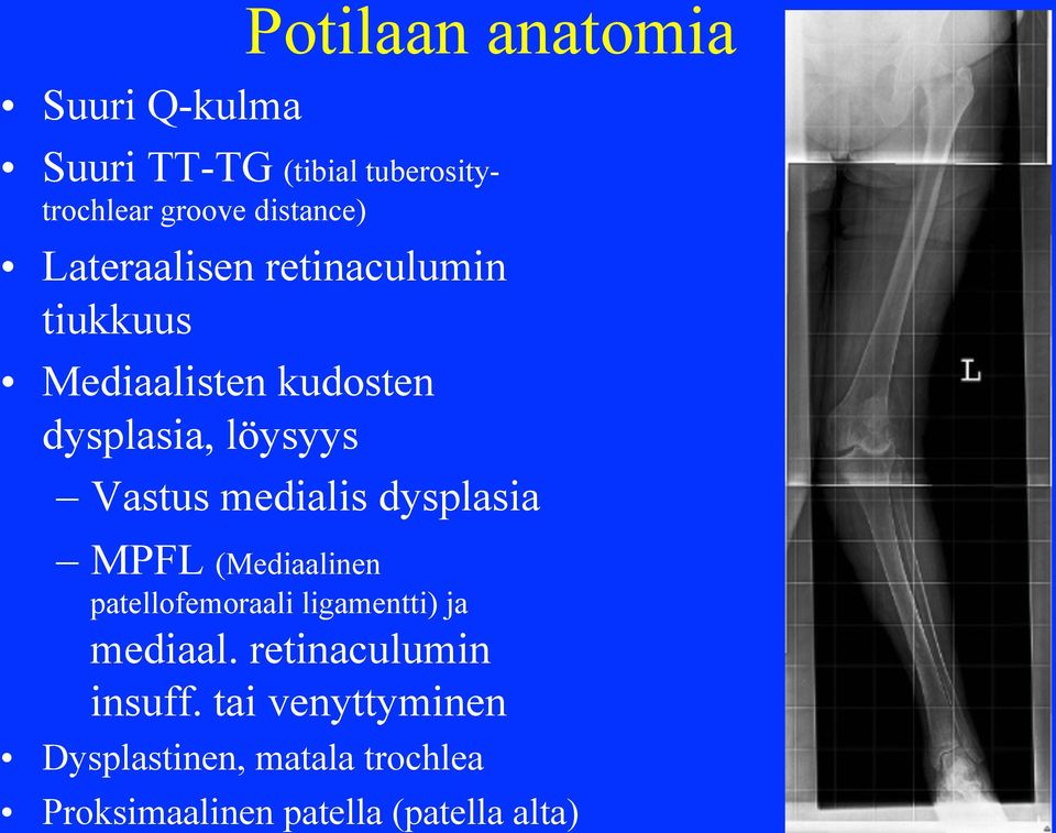 medialis dysplasia MPFL (Mediaalinen patellofemoraali ligamentti) ja mediaal.