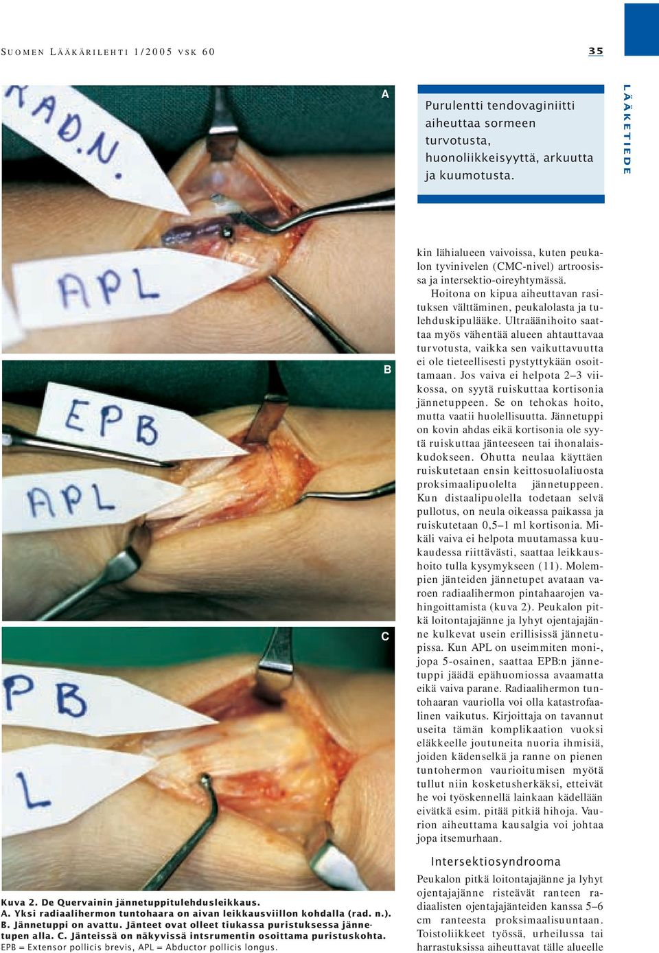 EPB = Extensor pollicis brevis, APL = Abductor pollicis longus. B C kin lähialueen vaivoissa, kuten peukalon tyvinivelen (CMC-nivel) artroosissa ja intersektio-oireyhtymässä.