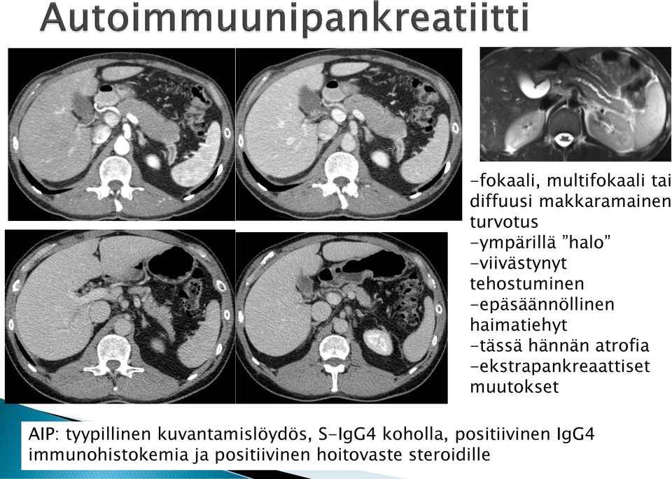 -ekstrapankreaattiset muutokset AIP: tyypillinen kuvantamislöydös, S-IgG4