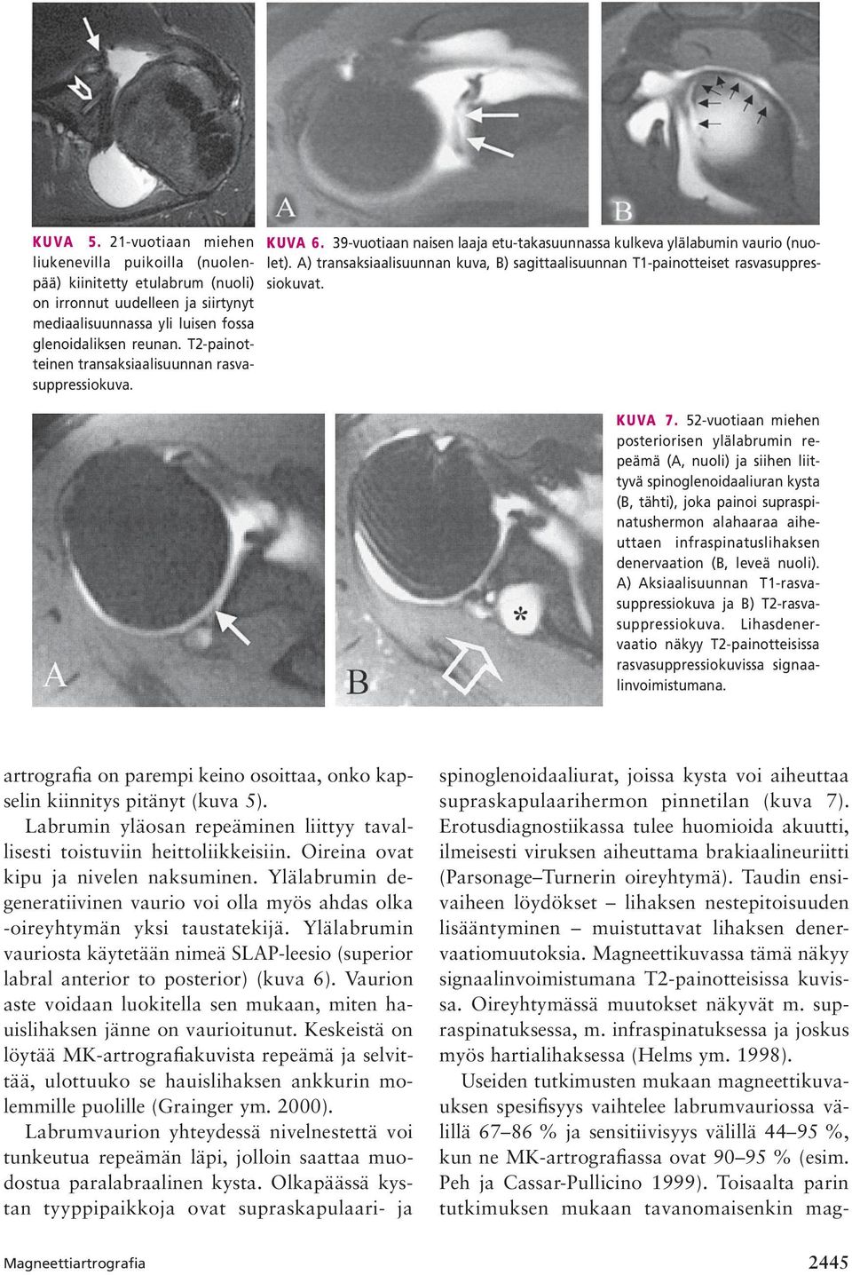 A) transaksiaalisuunnan kuva, B) sagittaalisuunnan T1-painotteiset rasvasuppressiokuvat. KUVA 7.