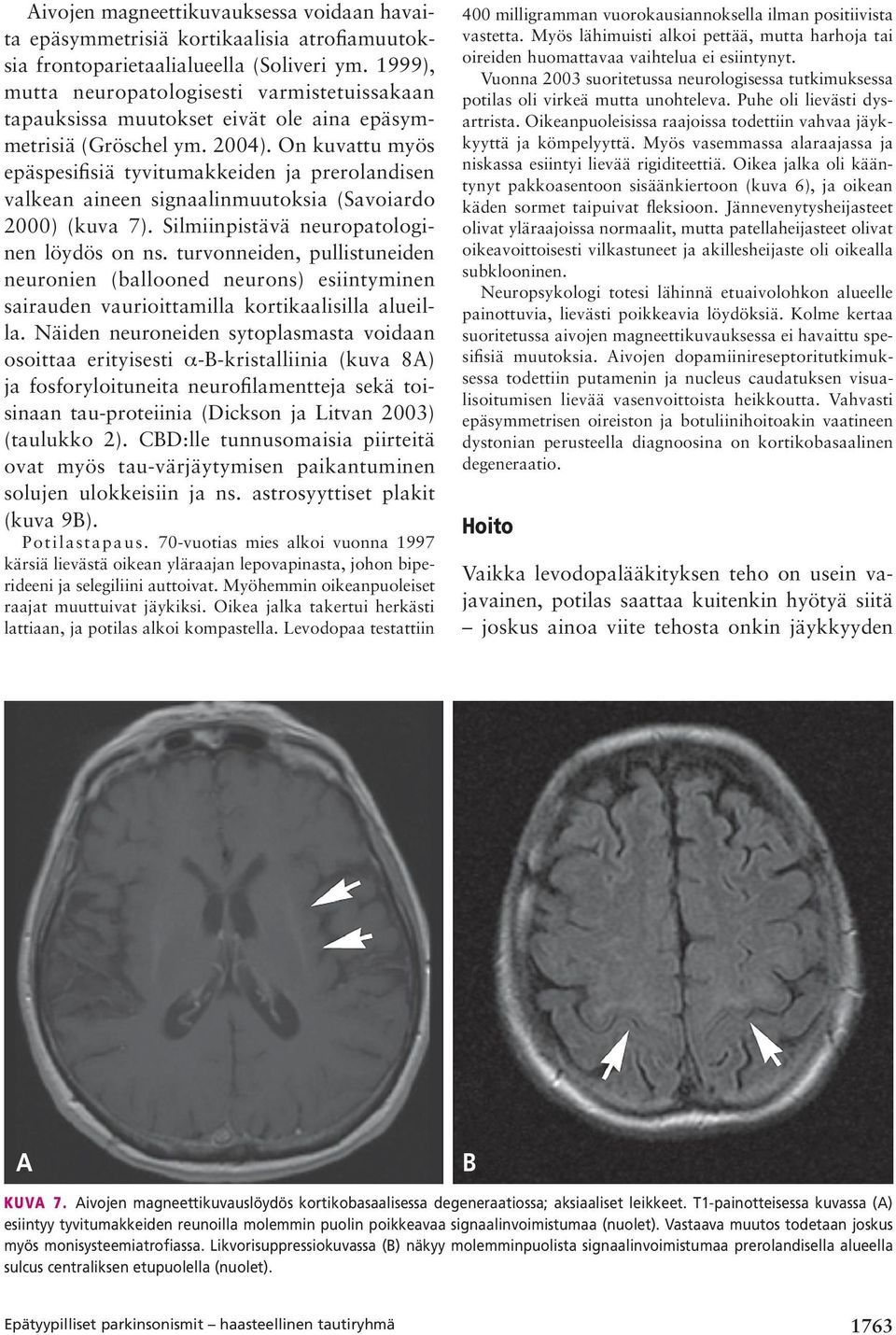 On kuvattu myös epäspesifisiä tyvitumakkeiden ja prerolandisen valkean aineen signaalinmuutoksia (Savoiardo 2000) (kuva 7). Silmiinpistävä neuropatologinen löydös on ns.
