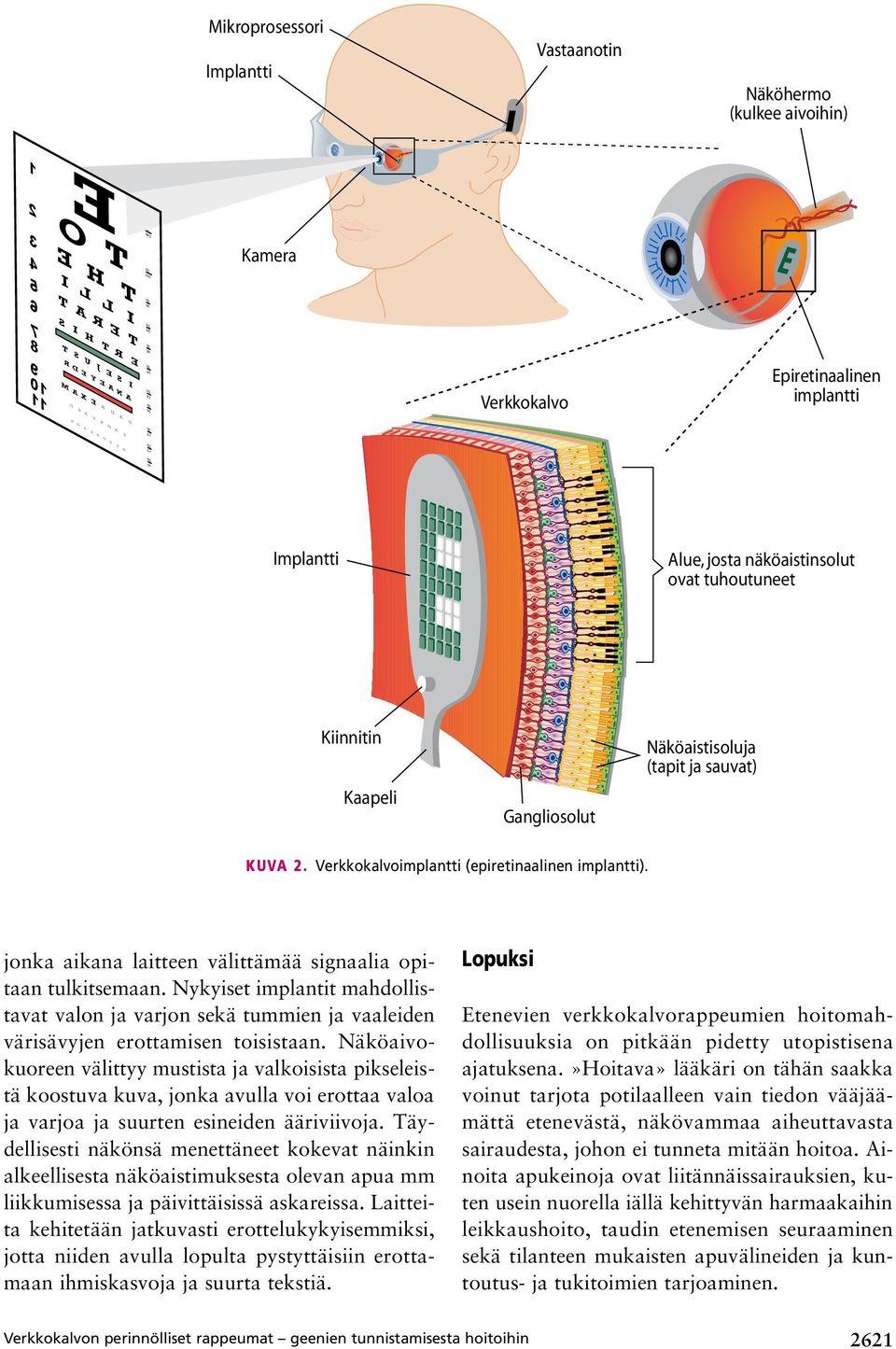 (tapit ja sauvat) Kuva 2. Verkkokalvoimplantti (epiretinaalinen implantti). jonka aikana laitteen välittämää signaalia opitaan tulkitsemaan.