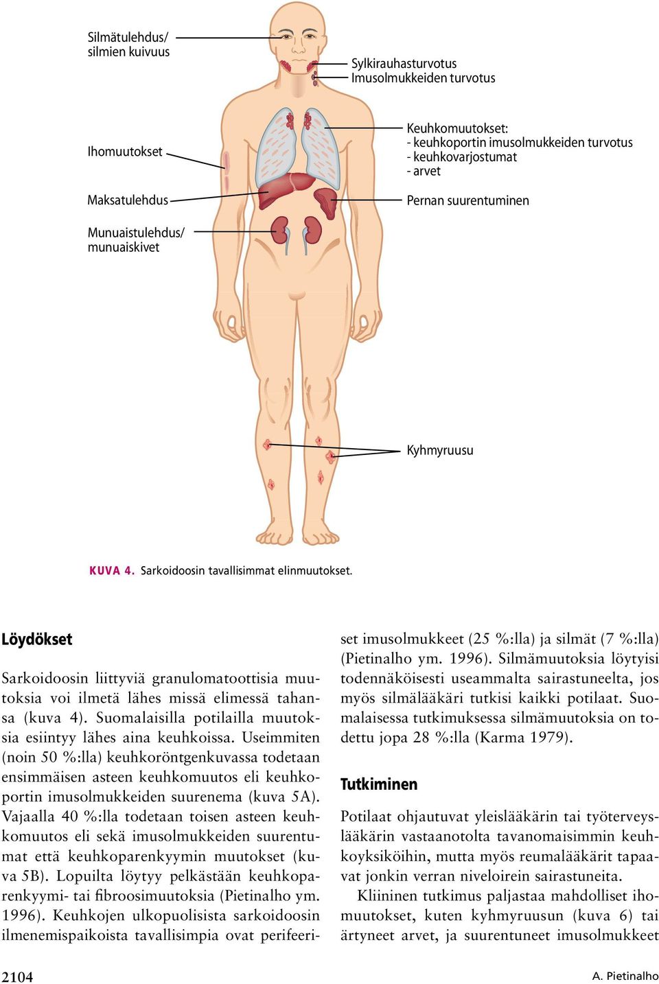 Löydökset Sarkoidoosin liittyviä granulomatoottisia muutoksia voi ilmetä lähes missä elimessä tahansa (kuva 4). Suomalaisilla potilailla muutoksia esiintyy lähes aina keuhkoissa.