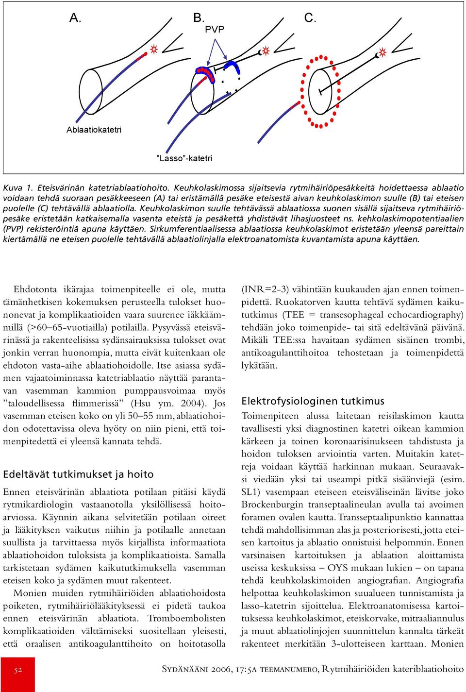 (C) tehtävällä ablaatiolla. Keuhkolaskimon suulle tehtävässä ablaatiossa suonen sisällä sijaitseva rytmihäiriöpesäke eristetään katkaisemalla vasenta eteistä ja pesäkettä yhdistävät lihasjuosteet ns.