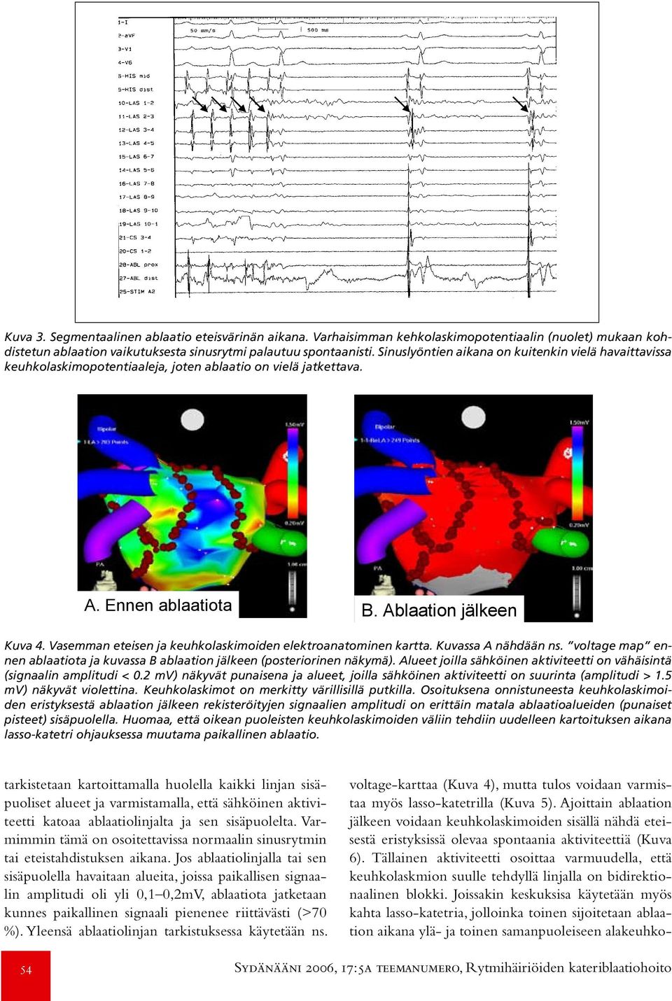 Vasemman eteisen ja keuhkolaskimoiden elektroanatominen kartta. Kuvassa A nähdään ns. voltage map ennen ablaatiota ja kuvassa B ablaation jälkeen (posteriorinen näkymä).