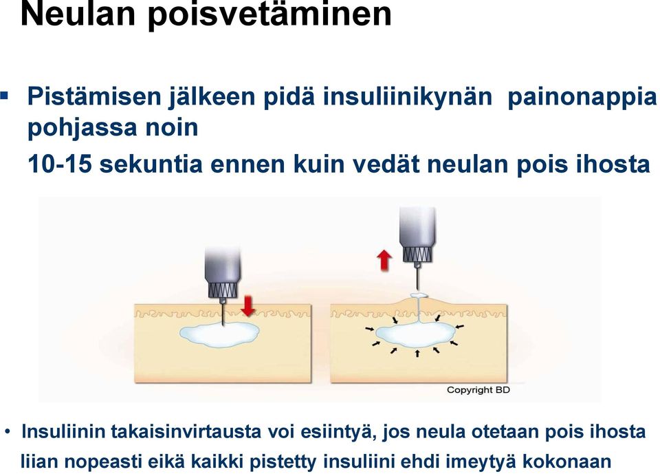 ihosta Insuliinin takaisinvirtausta voi esiintyä, jos neula otetaan