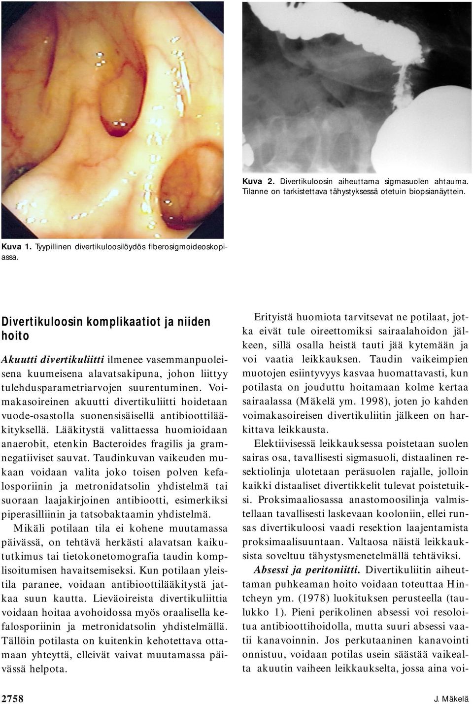 Voimakasoireinen akuutti divertikuliitti hoidetaan vuode-osastolla suonensisäisellä antibioottilääkityksellä.