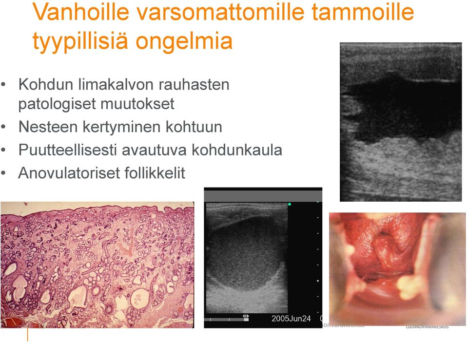 muutokset Nesteen kertyminen kohtuun