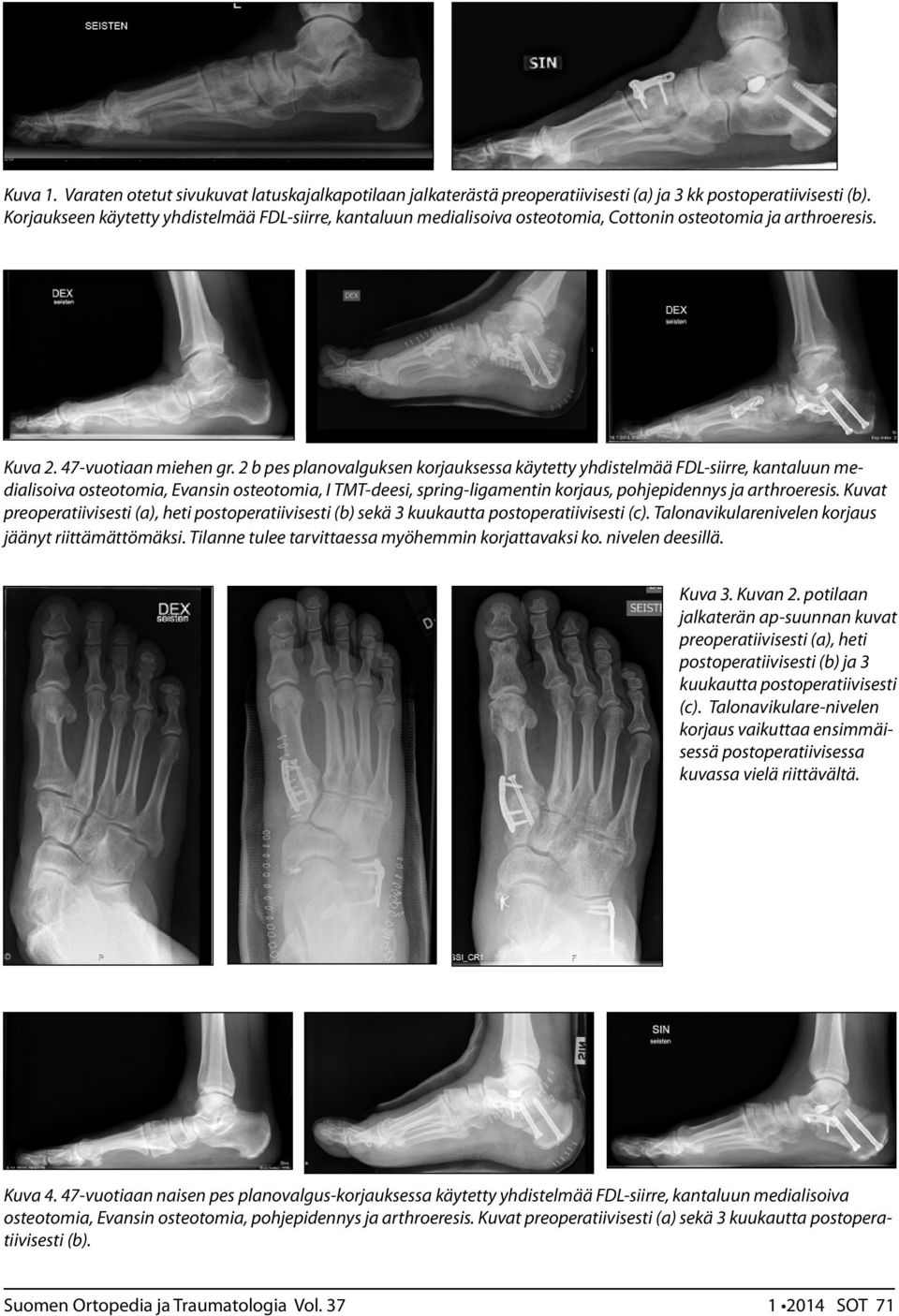 2 b pes planovalguksen korjauksessa käytetty yhdistelmää FDL-siirre, kantaluun medialisoiva osteotomia, Evansin osteotomia, I TMT-deesi, spring-ligamentin korjaus, pohjepidennys ja arthroeresis.