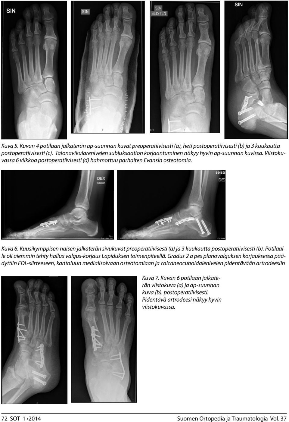 Kuusikymppisen naisen jalkaterän sivukuvat preoperatiivisesti (a) ja 3 kuukautta postoperatiivisesti (b). Potilaalle oli aiemmin tehty hallux valgus-korjaus Lapiduksen toimenpiteellä.