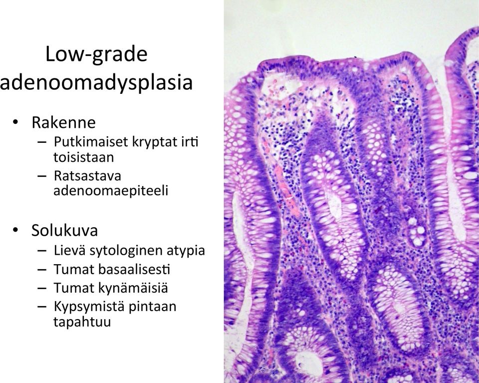 adenoomaepiteeli Solukuva Lievä sytologinen