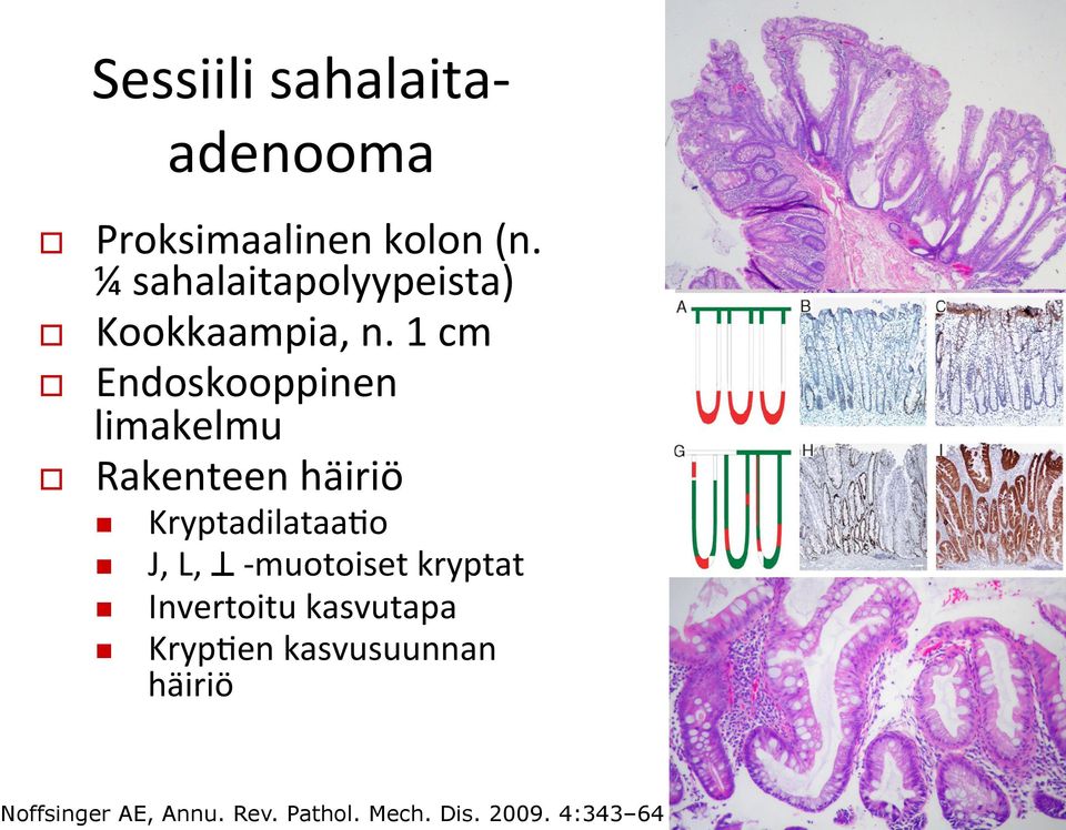 1 cm Endoskooppinen limakelmu Rakenteen häiriö n n n n KryptadilataaEo J, L,