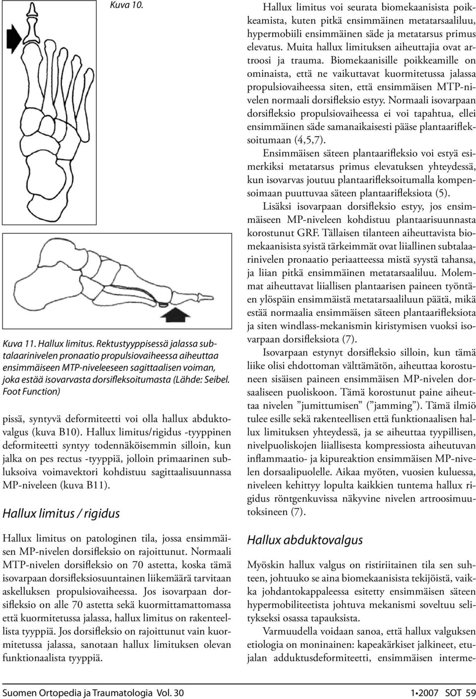 MP-niveleen (kuva B11). Hallux limitus 