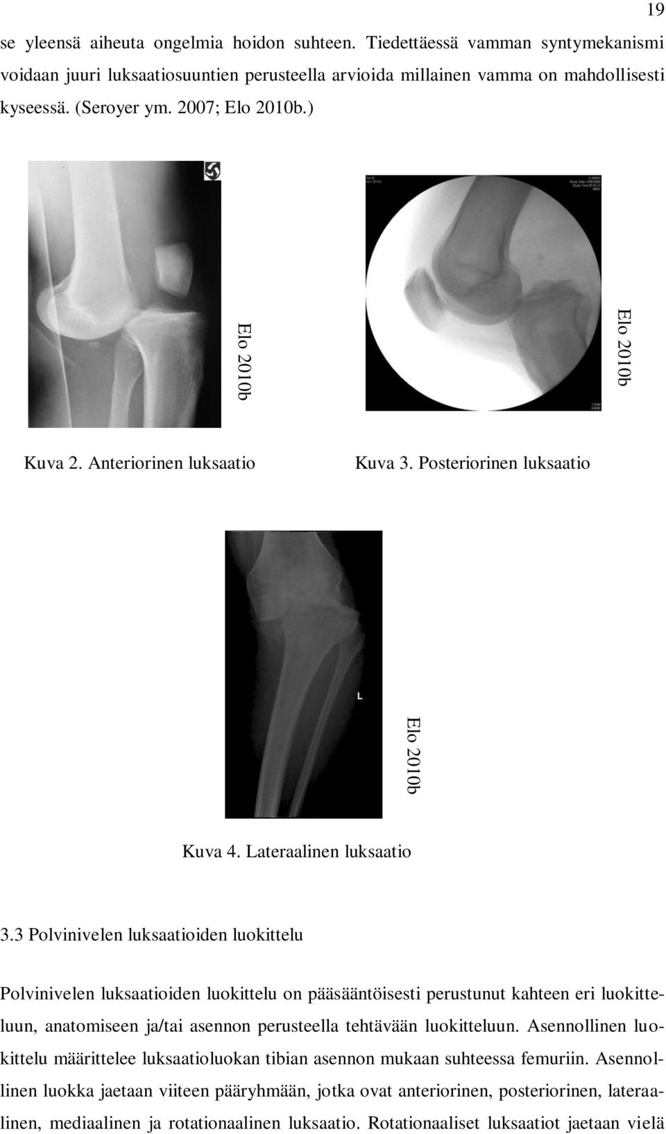 Posteriorinen luksaatio Kuva 4. Lateraalinen luksaatio 3.