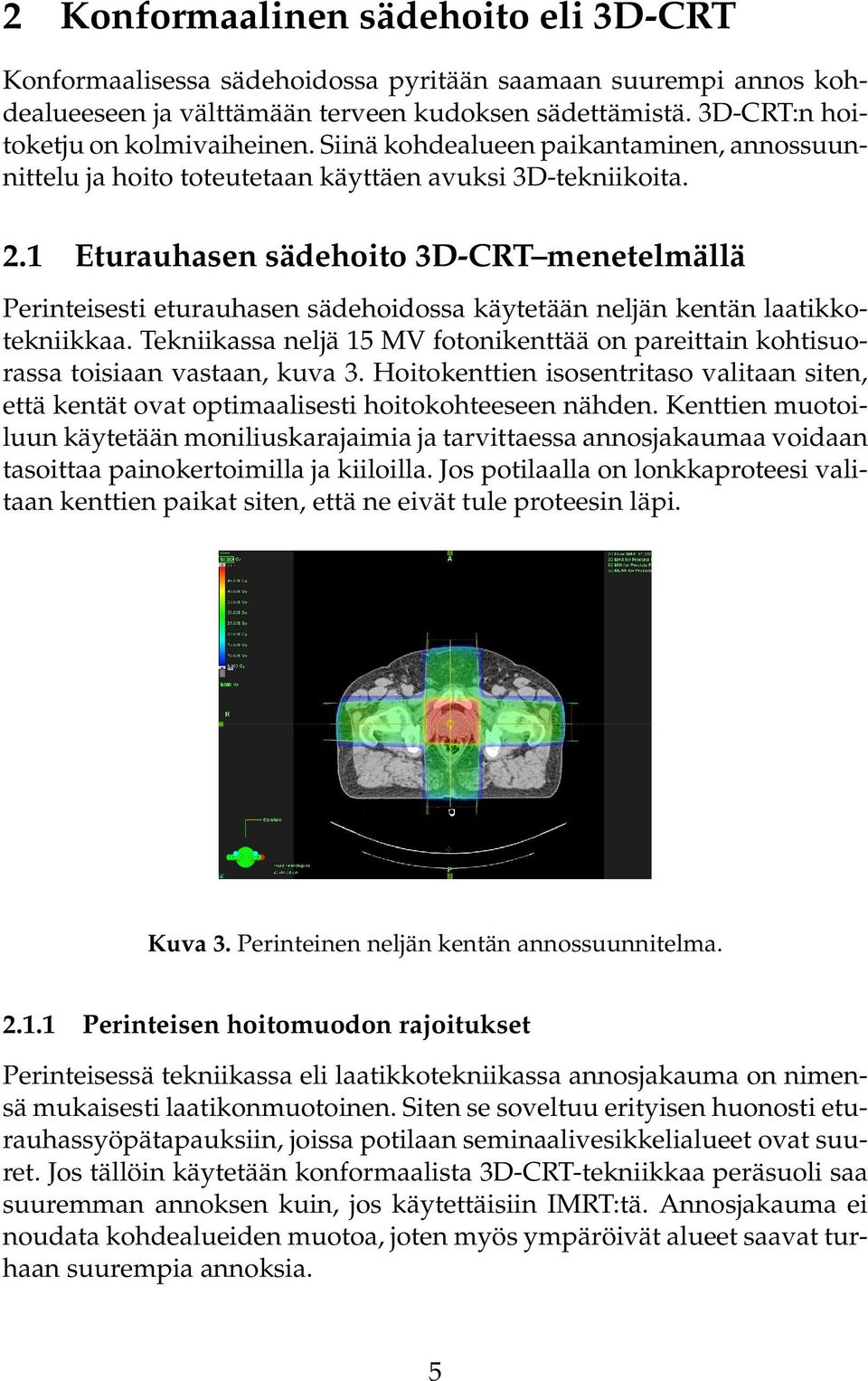 1 Eturauhasen sädehoito 3D-CRT menetelmällä Perinteisesti eturauhasen sädehoidossa käytetään neljän kentän laatikkotekniikkaa.