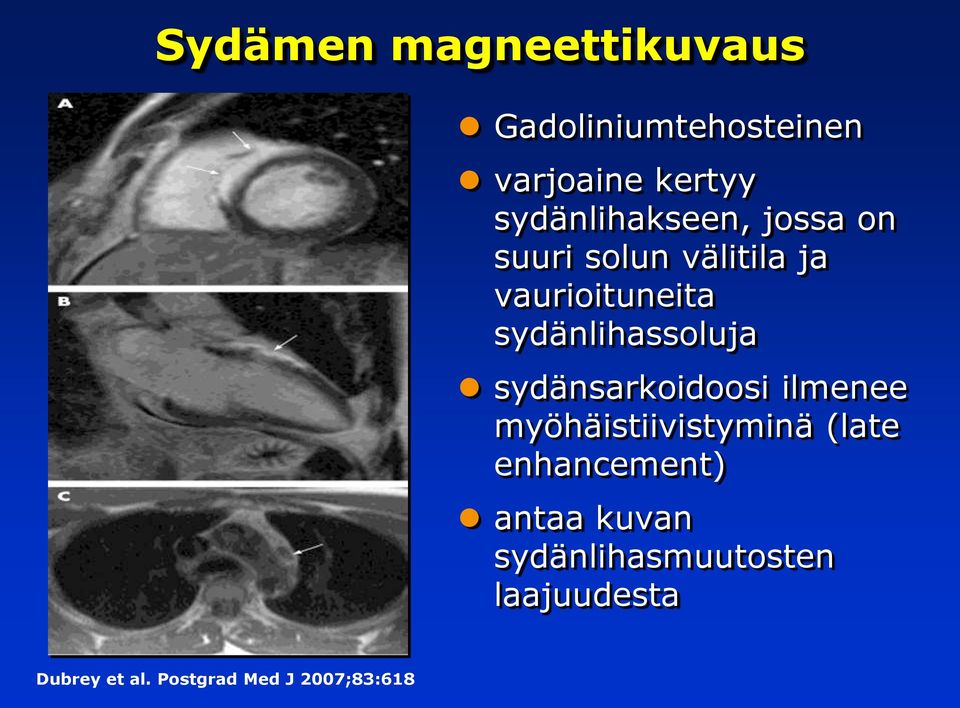 sydänlihassoluja sydänsarkoidoosi ilmenee myöhäistiivistyminä (late