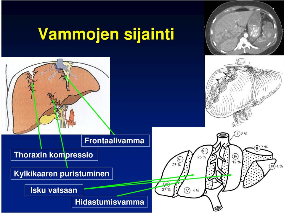 kompressio Kylkikaaren