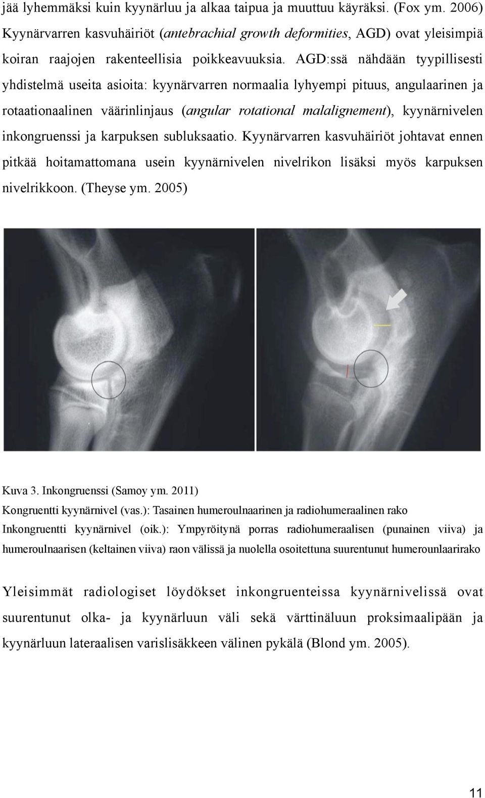AGD:ssä nähdään tyypillisesti yhdistelmä useita asioita: kyynärvarren normaalia lyhyempi pituus, angulaarinen ja rotaationaalinen väärinlinjaus (angular rotational malalignement), kyynärnivelen