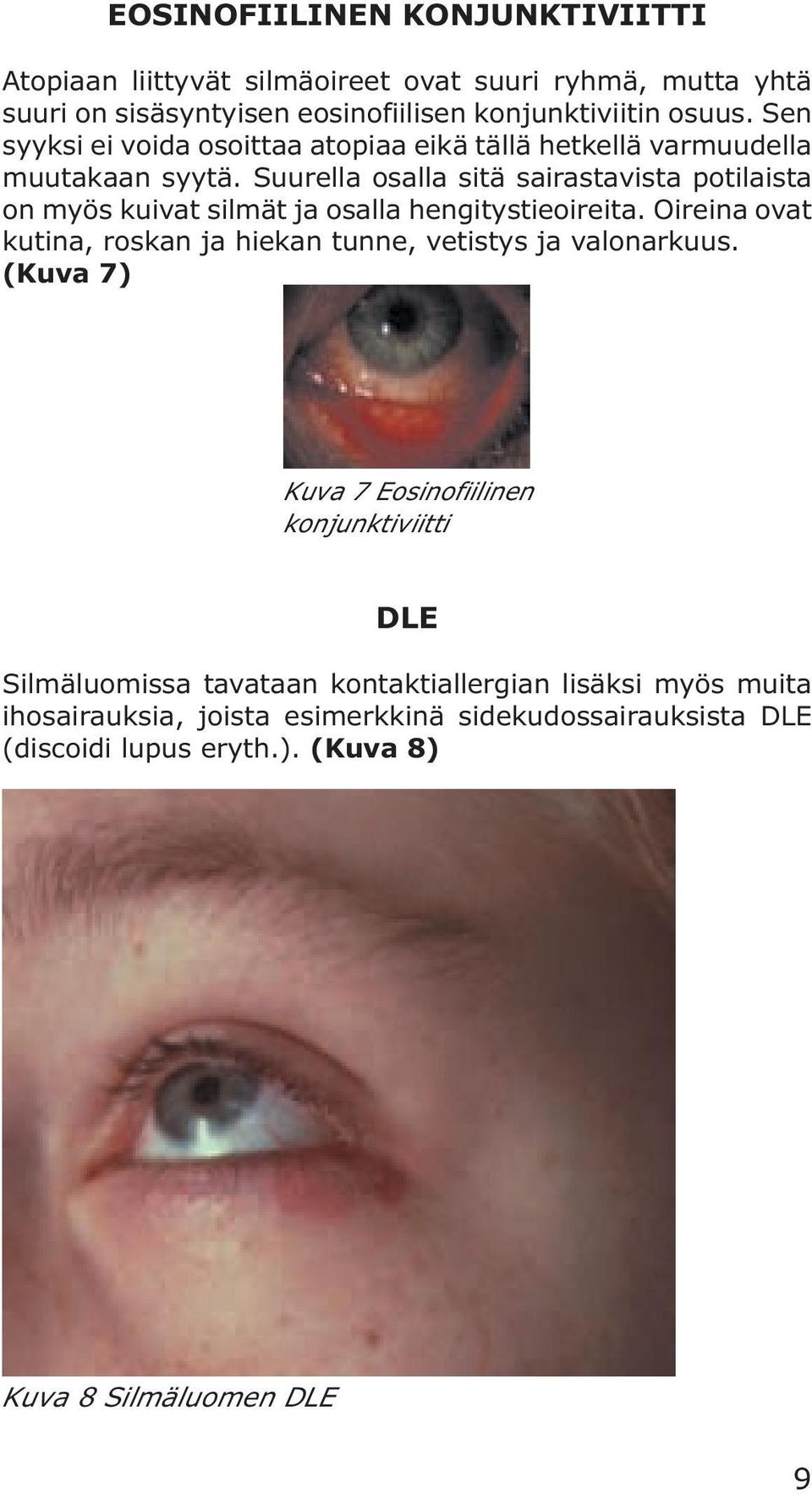 Suurella osalla sitä sairastavista potilaista on myös kuivat silmät ja osalla hengitystieoireita.