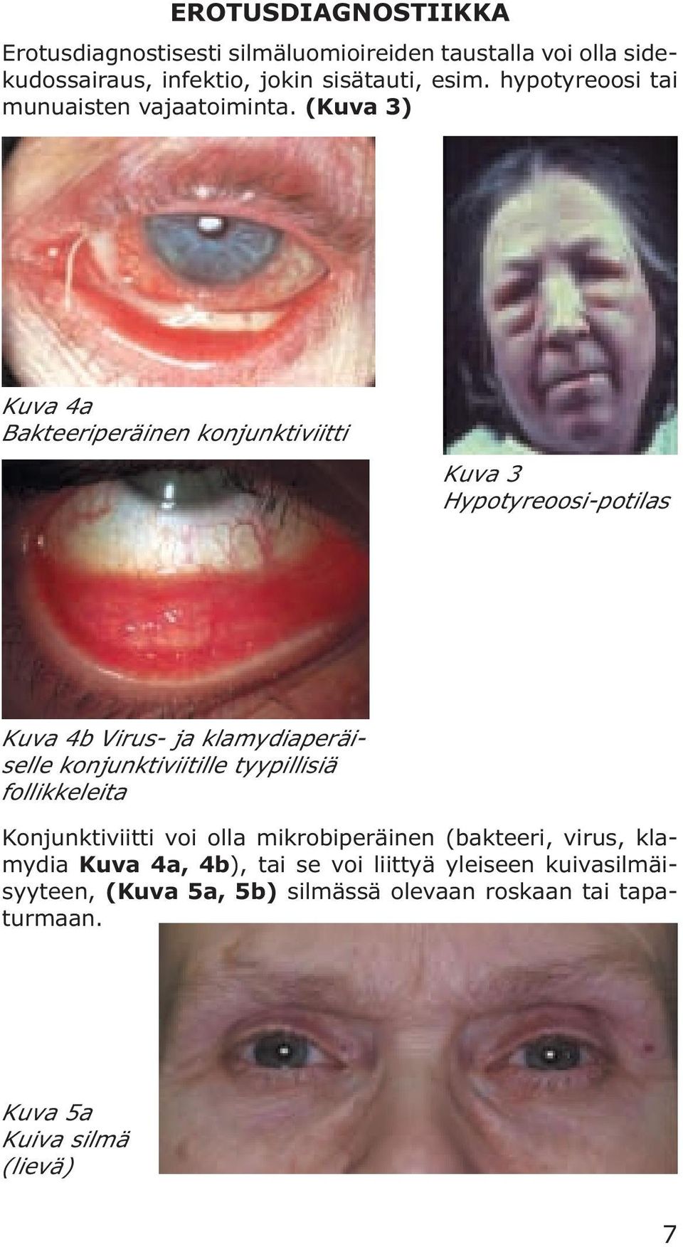 (Kuva 3) Kuva 4a Bakteeriperäinen konjunktiviitti Kuva 3 Hypotyreoosi-potilas Kuva 4b Virus- ja klamydiaperäiselle konjunktiviitille
