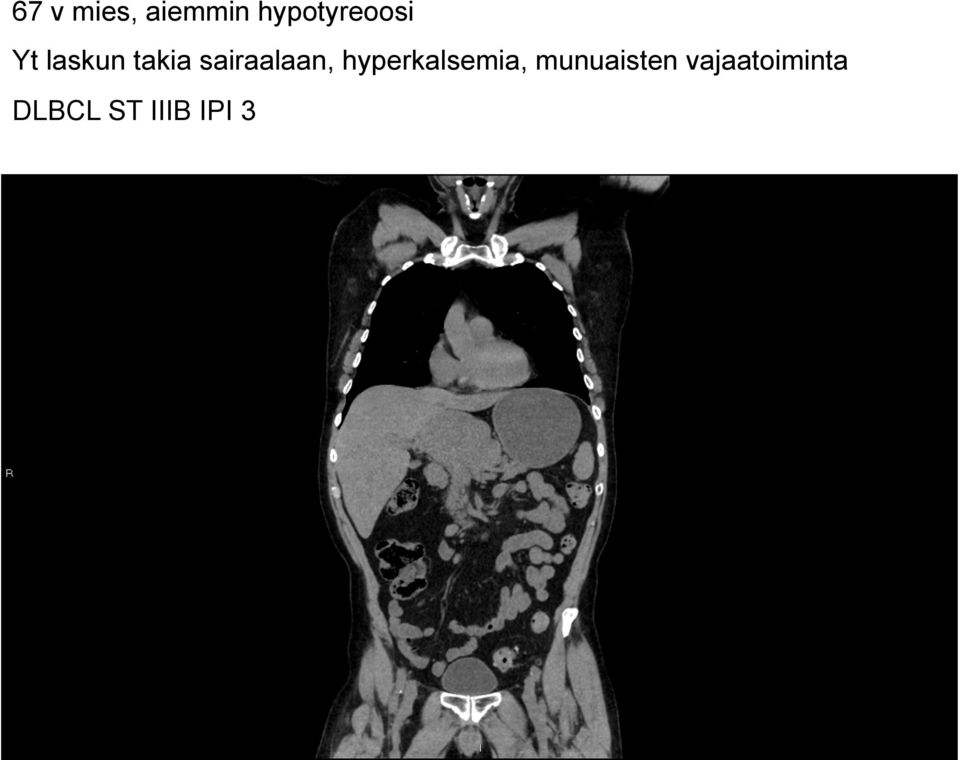 sairaalaan, hyperkalsemia,