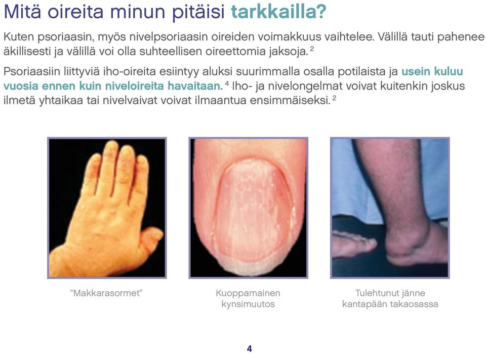 2 Psoriaasiin liittyviä iho-oireita esiintyy aluksi suurimmalla osalla potilaista ja usein kuluu vuosia ennen kuin niveloireita