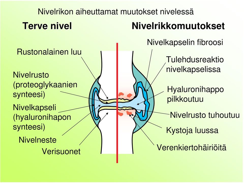 (hyaluronihapon synteesi) Nivelneste Verisuonet Nivelkapselin fibroosi