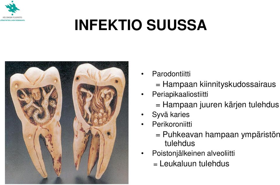 juuren kärjen tulehdus Syvä karies Perikoroniitti =