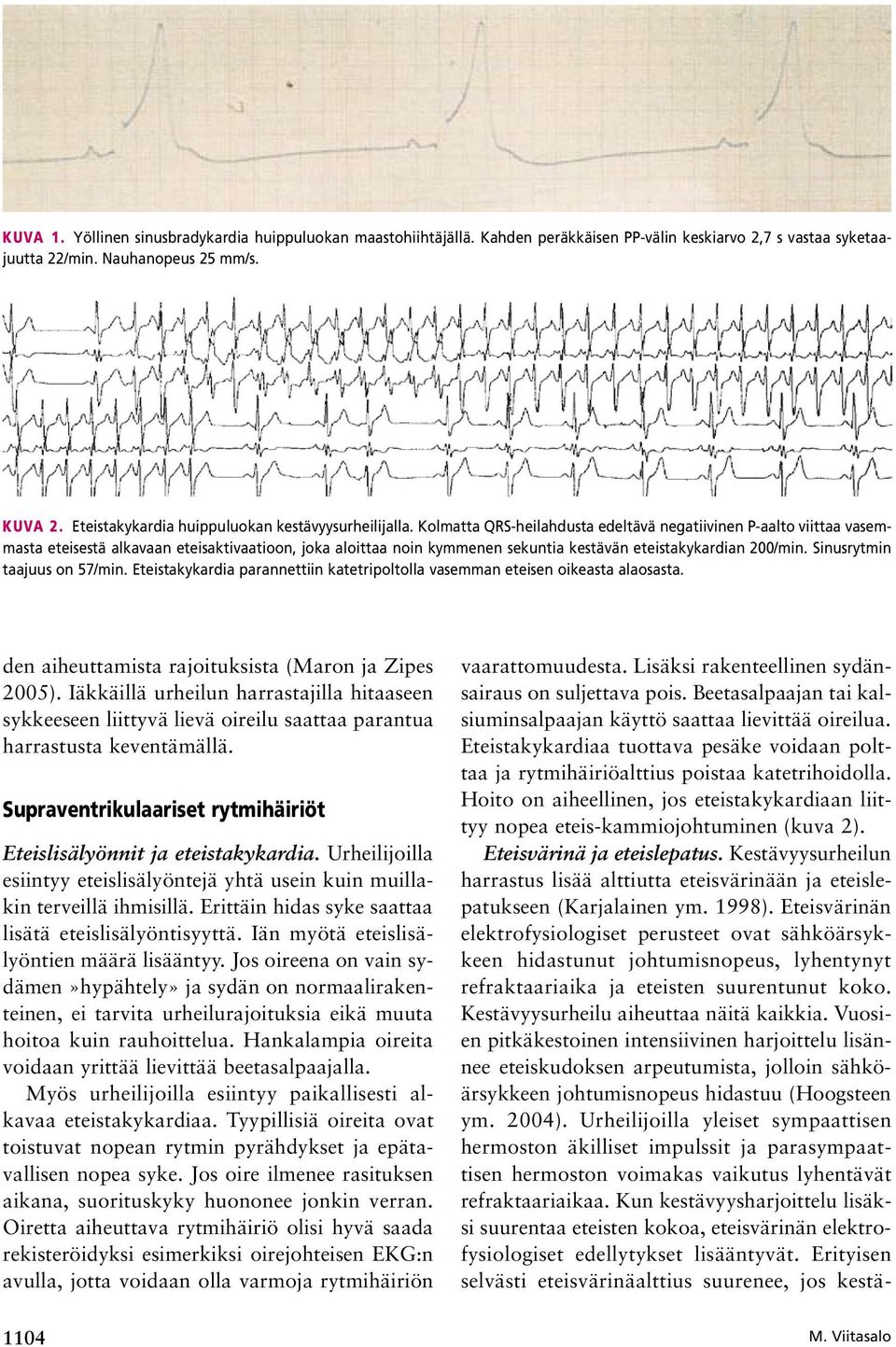 Kolmatta QRS-heilahdusta edeltävä negatiivinen P-aalto viittaa vasemmasta eteisestä alkavaan eteisaktivaatioon, joka aloittaa noin kymmenen sekuntia kestävän eteistakykardian 200/min.