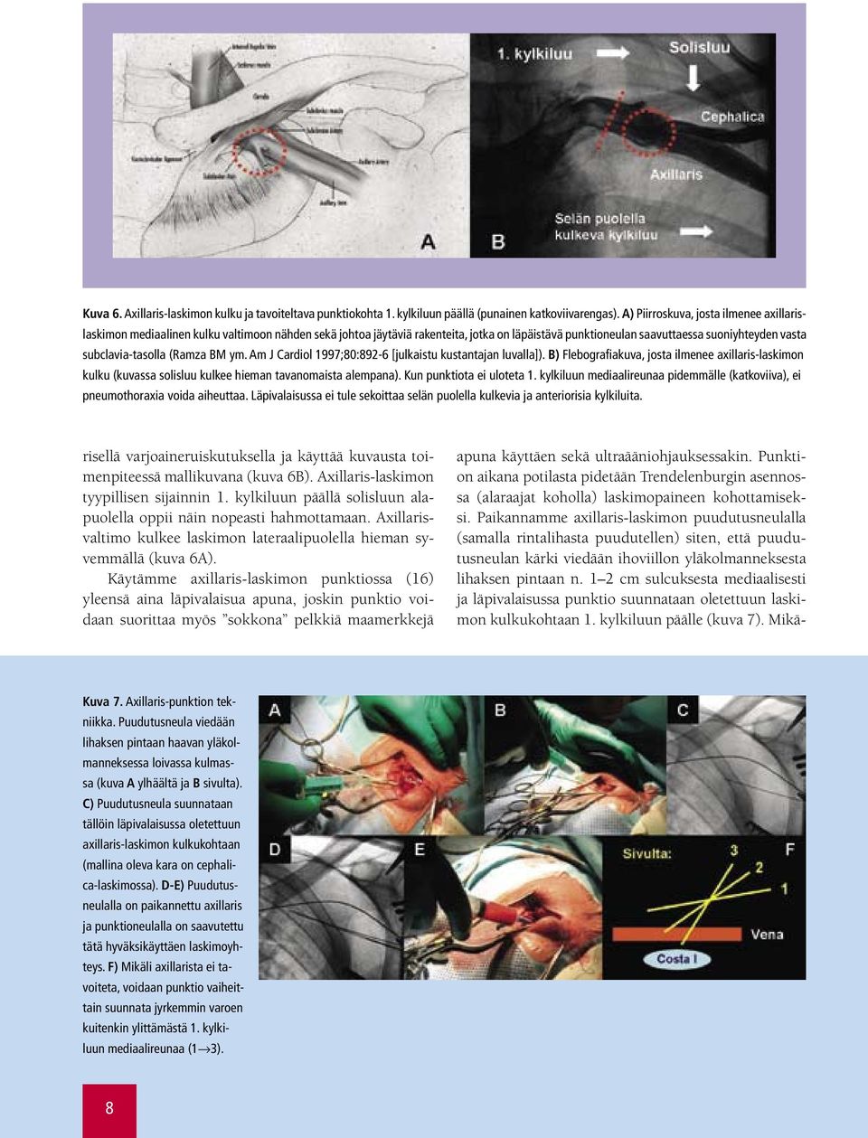 subclavia-tasolla (Ramza BM ym. Am J Cardiol 1997;80:892-6 [julkaistu kustantajan luvalla]).