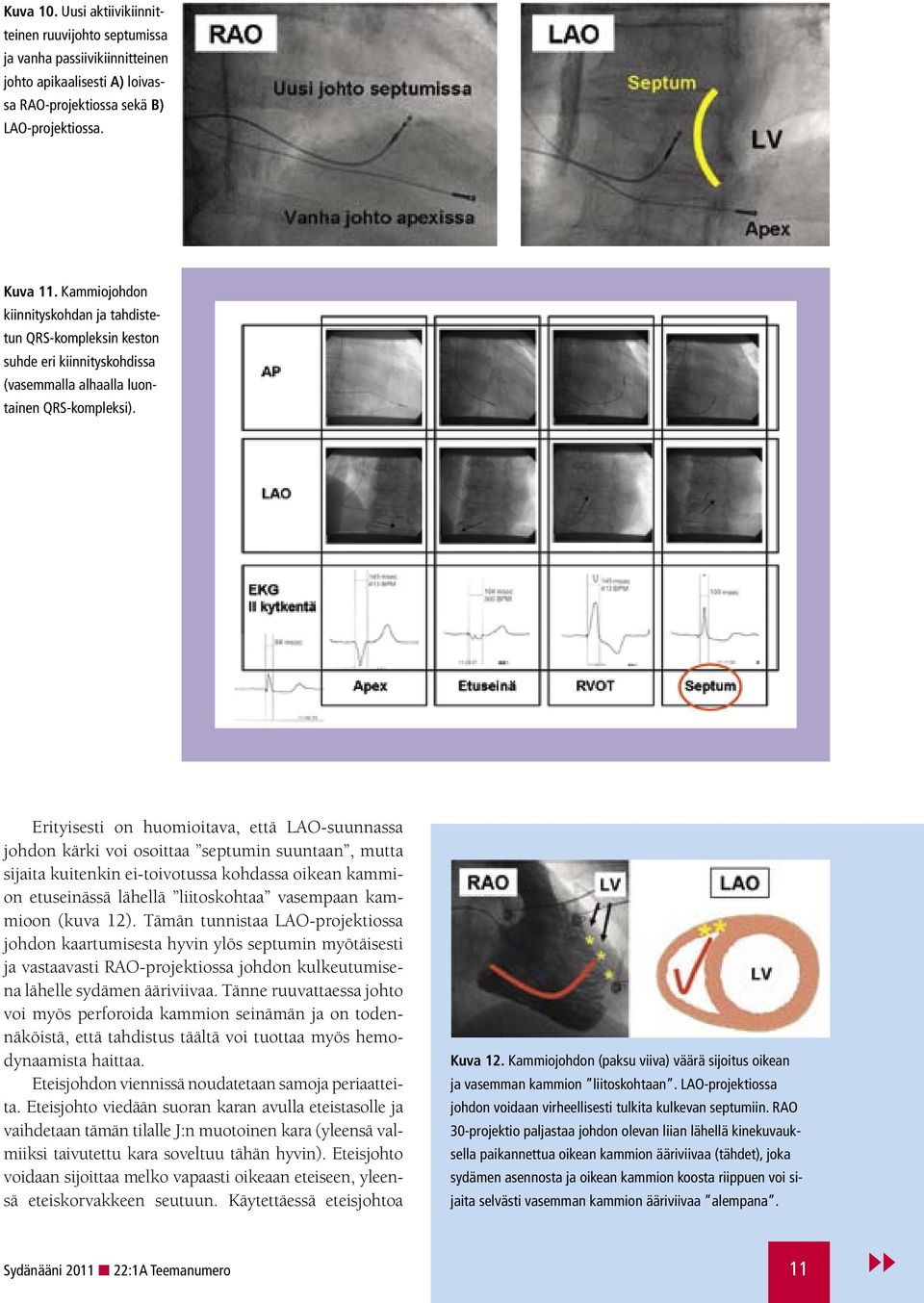 Erityisesti on huomioitava, että LAO-suunnassa johdon kärki voi osoittaa septumin suuntaan, mutta sijaita kuitenkin ei-toivotussa kohdassa oikean kammion etuseinässä lähellä liitoskohtaa vasempaan