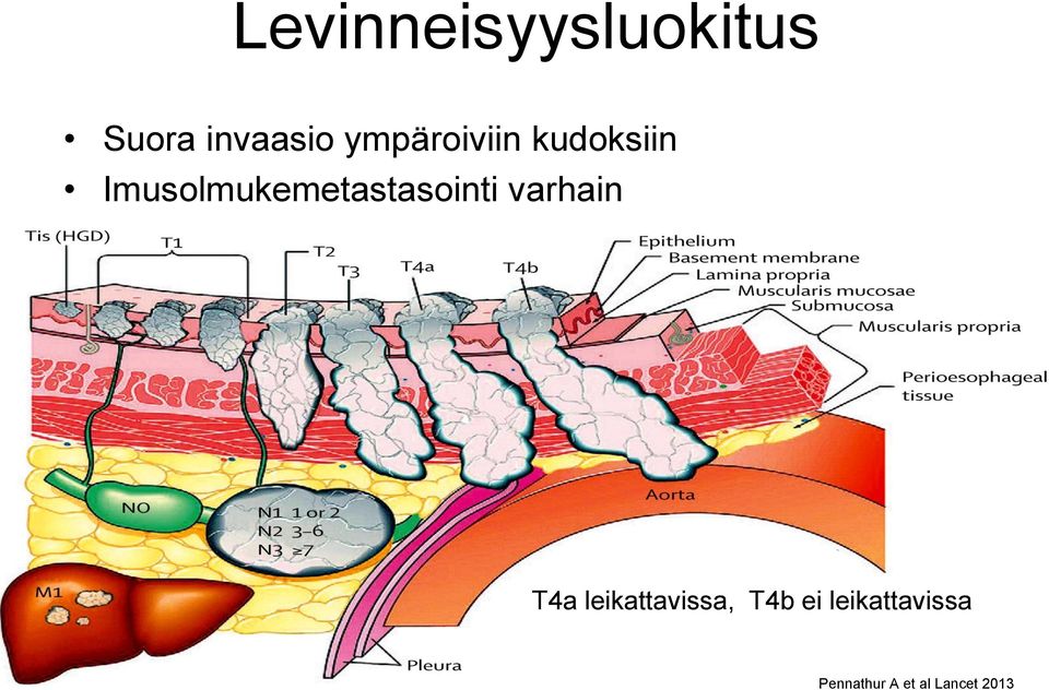 Imusolmukemetastasointi varhain T4a