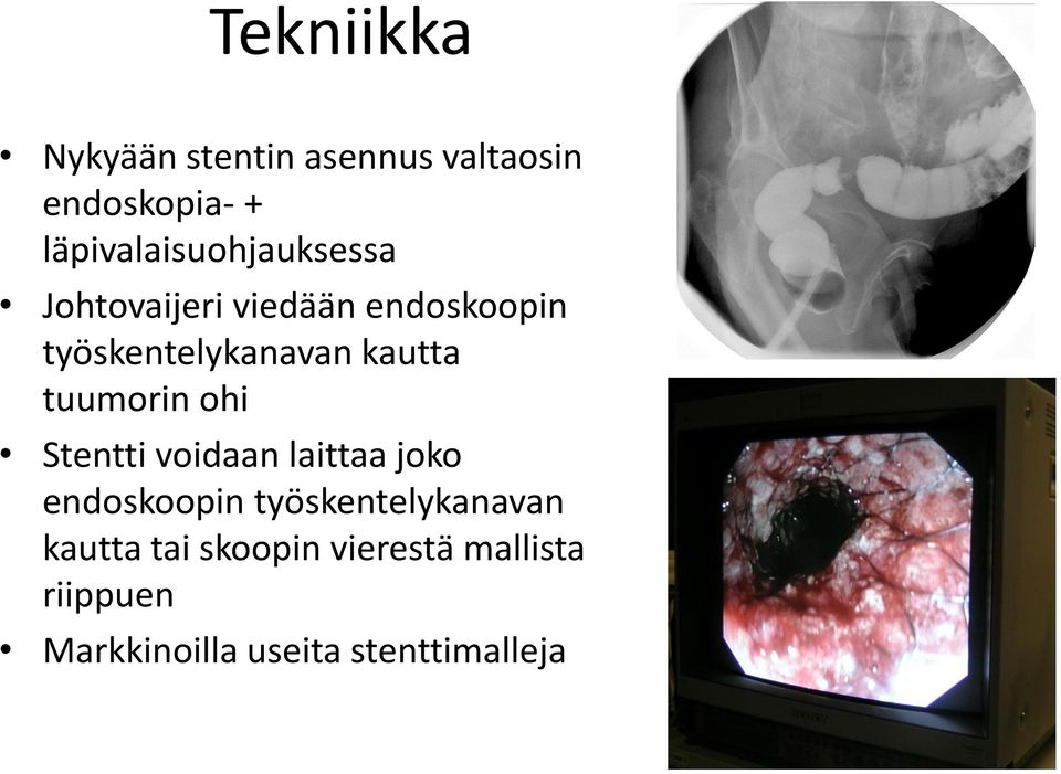 työskentelykanavan kautta tuumorin ohi Stentti voidaan laittaa joko