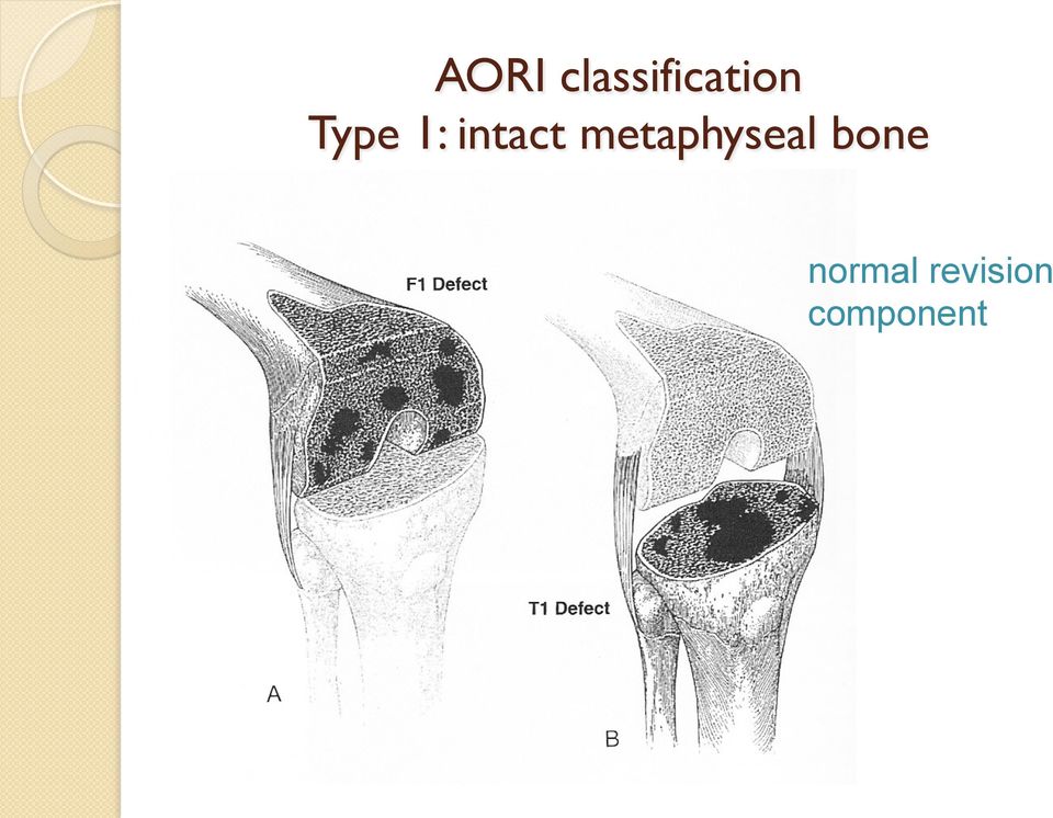 metaphyseal bone