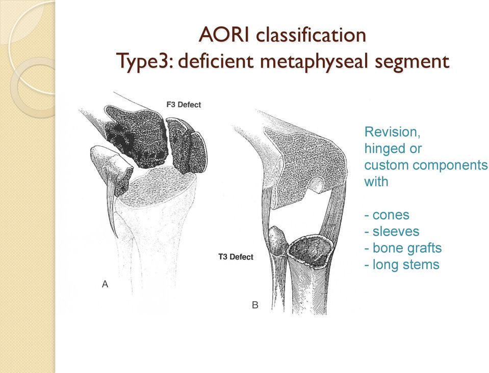 Revision, hinged or custom